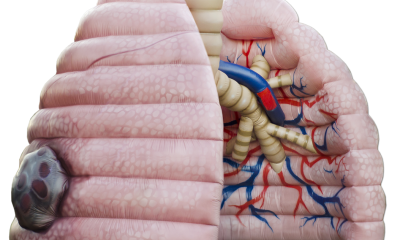 Illustration of lungs with tumor 